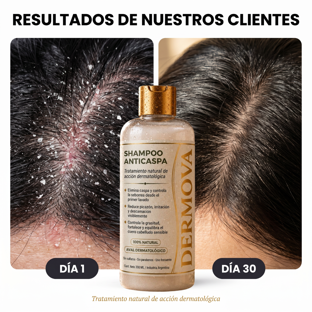 DERMOVA® - Shampoo Anticaspa, Seborrea y Picazón de Acción Dermatológica