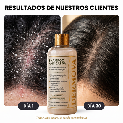DERMOVA® - Shampoo Anticaspa, Seborrea y Picazón de Acción Dermatológica