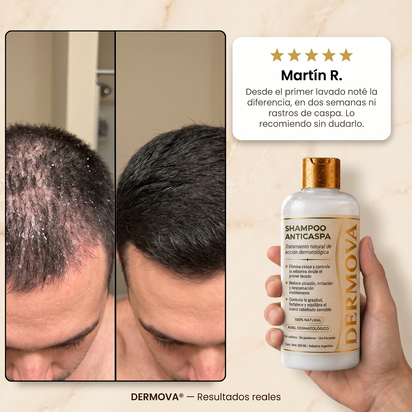 DERMOVA® - Shampoo Anticaspa, Seborrea y Picazón de Acción Dermatológica