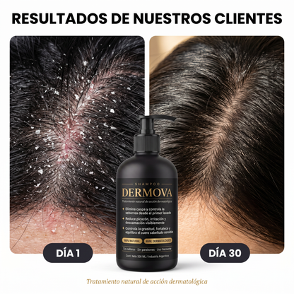 DERMOVA® - Shampoo Anticaspa, Seborrea y Picazón de Acción Dermatológica