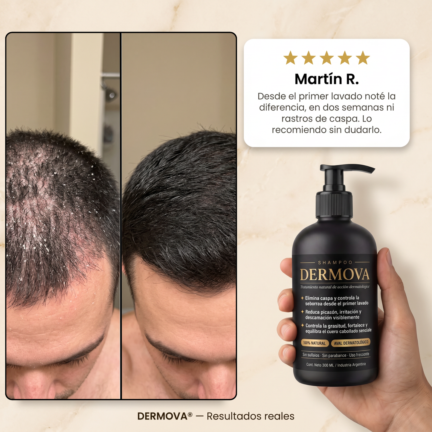 DERMOVA® - Shampoo Anticaspa, Seborrea y Picazón de Acción Dermatológica